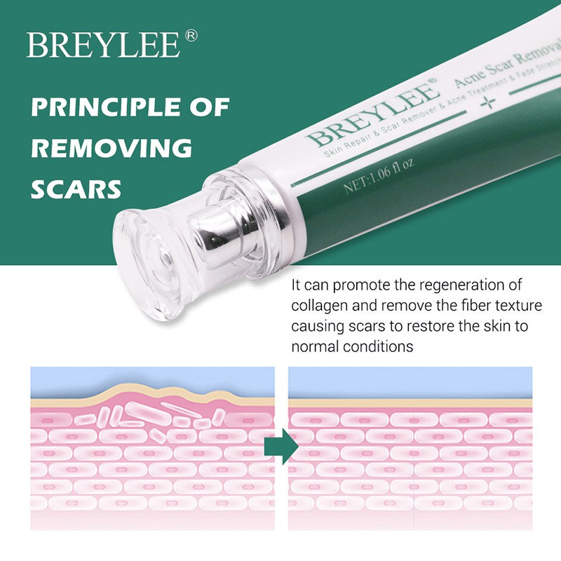 BREYLEE Acne Scar Removal Cream Skin Repair Skin Care Scar Acne Treatment Remove Stretch Marks Whitening Cream - Tuzzut.com Qatar Online Shopping