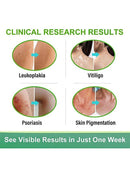 Vitiligo Removal Cream, Skin Vitiligo Treatment, Vitiligo Care Cream Reduces White Spots and Improves Skin Pigmentation (20g) B-389470 - TUZZUT Qatar Online Shopping