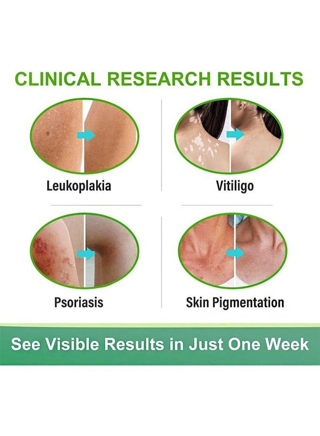 Vitiligo Removal Cream, Skin Vitiligo Treatment, Vitiligo Care Cream Reduces White Spots and Improves Skin Pigmentation (20g) B-389470 - TUZZUT Qatar Online Shopping