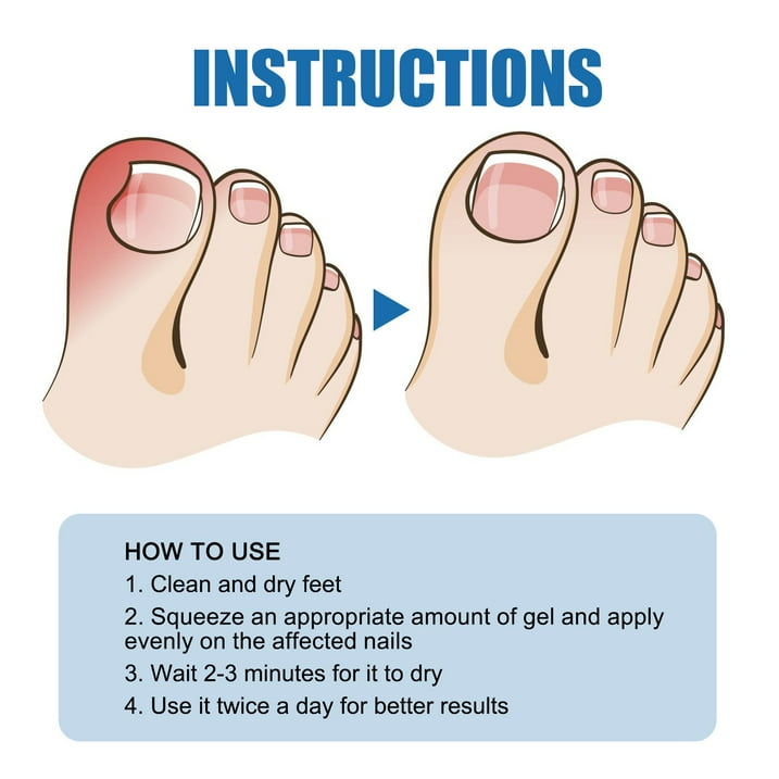 Toe Fungus Hand Foot Removal Gel Nail