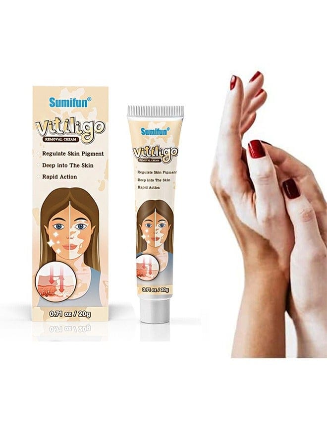 Vitiligo Removal Cream, Skin Vitiligo Treatment, Vitiligo Care Cream Reduces White Spots and Improves Skin Pigmentation (20g) B-389470 Vitiligo Removal Cream, Skin Vitiligo Treatment, Vitiligo Care Cream Reduces White Spots and Improves Skin Pigmentation (20g) B-389470