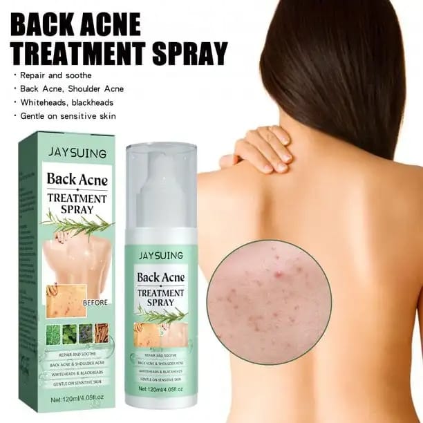 Back Acne Treatment Spray, 120ml - Tuzzut.com Qatar Online Shopping