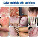 SOUTH MOON Psoriasis Removal Ointment Eczema Best Anti Dermatitis - Tuzzut.com Qatar Online Shopping