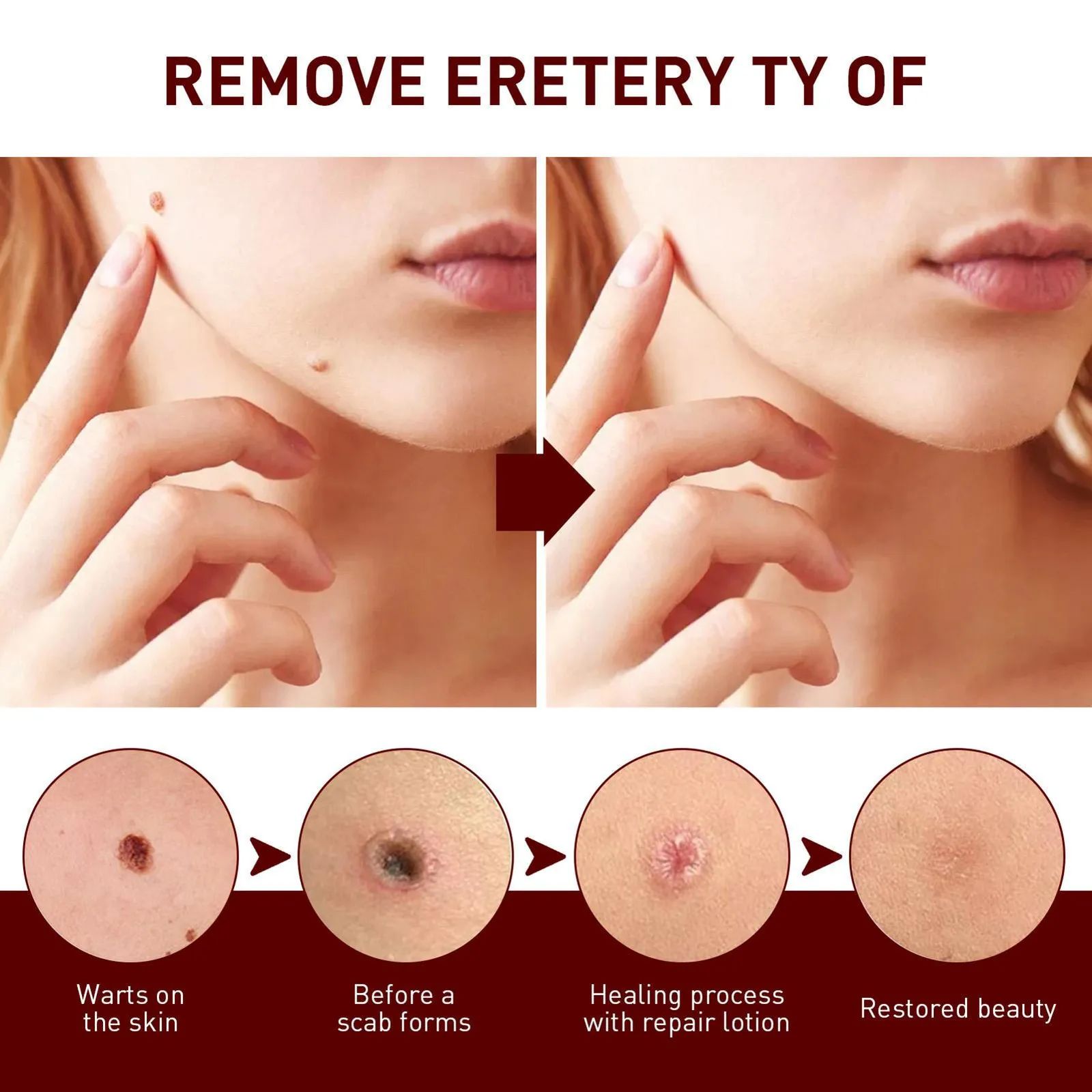 Wipe Off Tags and Mole Remover, Extreme Skin Tag Wipe Off Tags & Mole Remover 3ml Wipe Off Tags and Mole Remover, Extreme Skin Tag Wipe Off Tags & Mole Remover 3ml