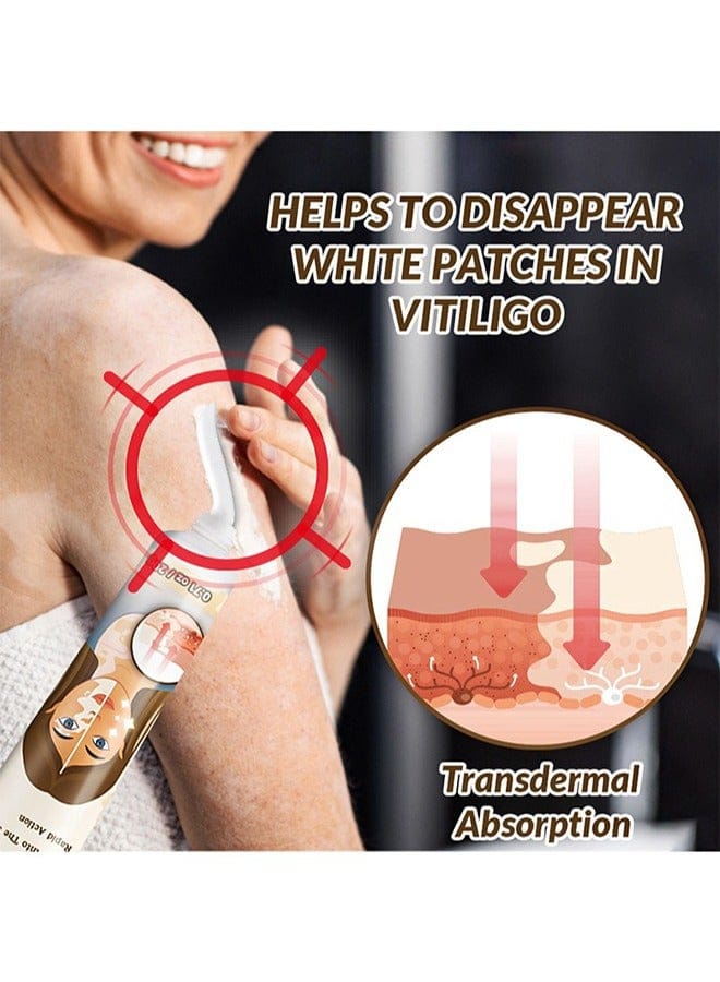 Vitiligo Removal Cream, Skin Vitiligo Treatment, Vitiligo Care Cream Reduces White Spots and Improves Skin Pigmentation (20g) B-389470 Vitiligo Removal Cream, Skin Vitiligo Treatment, Vitiligo Care Cream Reduces White Spots and Improves Skin Pigmentation (20g) B-389470