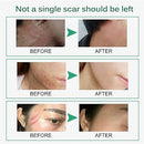 Scar Remove Cream Desalination Acne Mark Repair Scars Scarless Scald Scars - Tuzzut.com Qatar Online Shopping