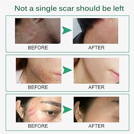 Scar Remove Cream Desalination Acne Mark Repair Scars Scarless Scald Scars Scar Remove Cream Desalination Acne Mark Repair Scars Scarless Scald Scars