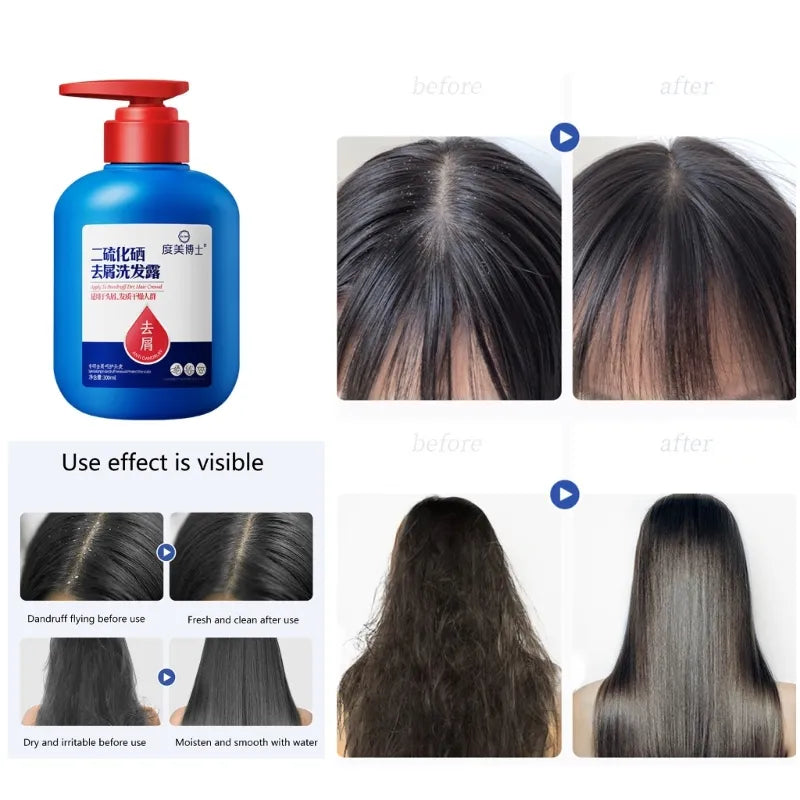 Anti-Dandruff Selenium Disulfide Shampoo - 300ml Anti-Dandruff Selenium Disulfide Shampoo - 300ml