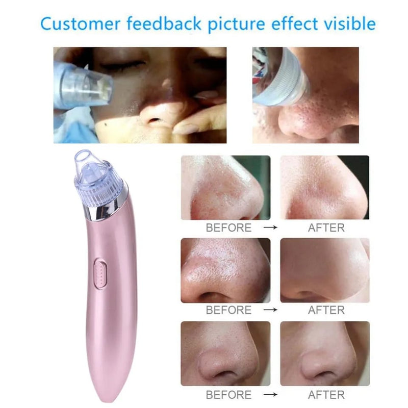 Electric Blackhead Remover Acne Pro Vacuum Pore Cleaner Exfoliating Cleansing Comedo Suction Facial Beauty Machine X2674310 - Tuzzut.com Qatar Online Shopping