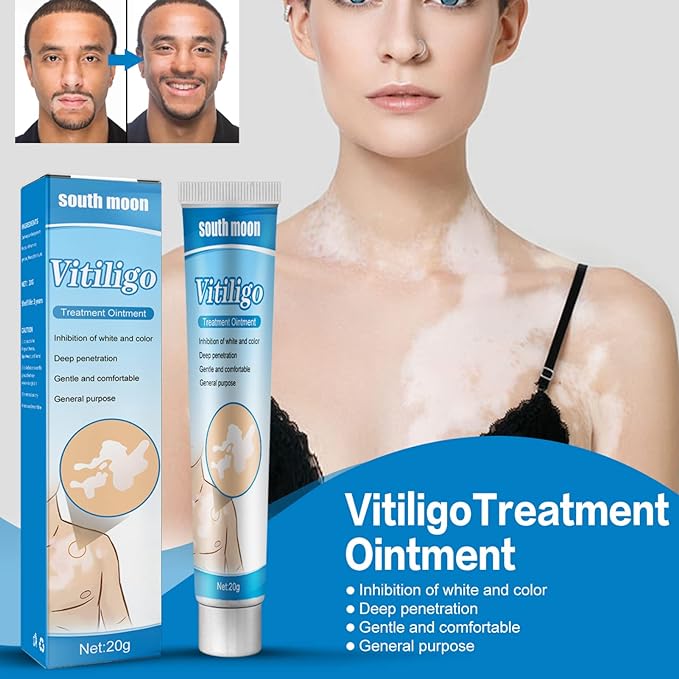 Vitiligo Cream, White Spots Vitiligo Treatment Ointment - Tuzzut.com Qatar Online Shopping