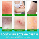 Natural Herbal Eczema Pruritus Psoriasis Ointment，Psoriasis Creams - Psoriasis Treatment, Antibacterial Cream,for Body Itching - TUZZUT Qatar Online Shopping