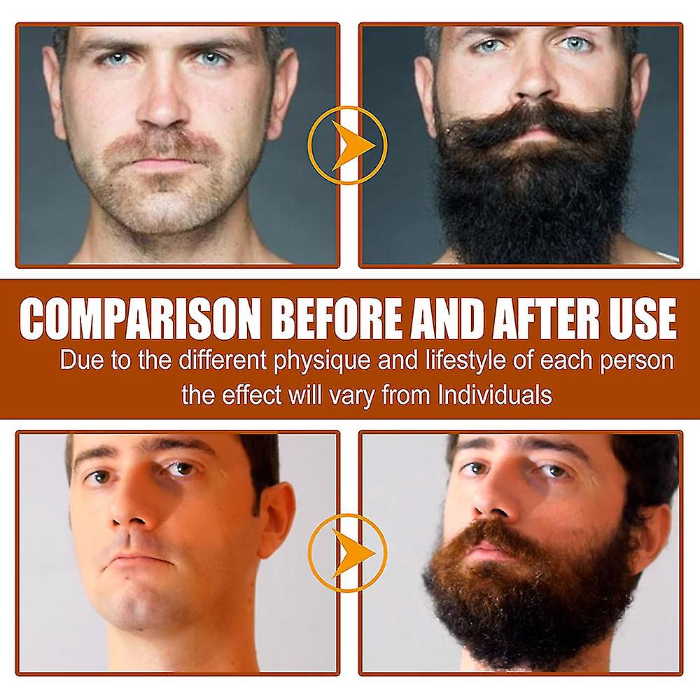 Beard Growth Essence Micro Needle Roller Beard Growth Essence Micro Needle Roller