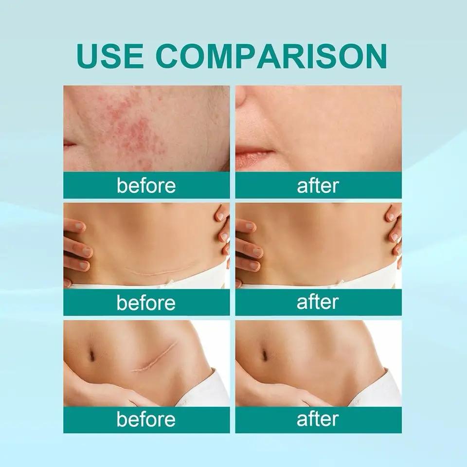 South Moon Scar Removal Spray Fade Scar -20g South Moon Scar Removal Spray Fade Scar -20g