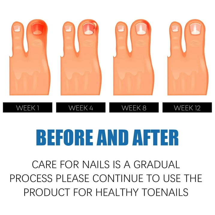 Toe Fungus Hand Foot Removal Gel Nail Toe Fungus Hand Foot Removal Gel Nail
