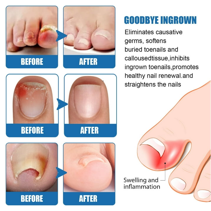 Toe Fungus Hand Foot Removal Gel Nail