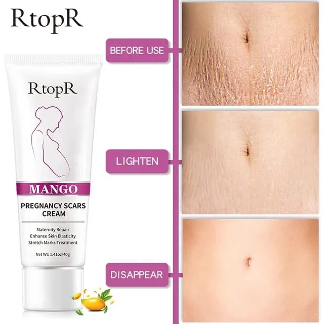 RtopR Natural Herbal Mango Stretch Marks and Scar Removal Cream for Pregnancy - Tuzzut.com Qatar Online Shopping
