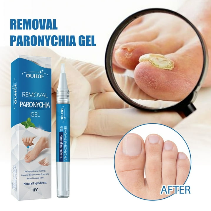 Toe Fungus Hand Foot Removal Gel Nail Toe Fungus Hand Foot Removal Gel Nail