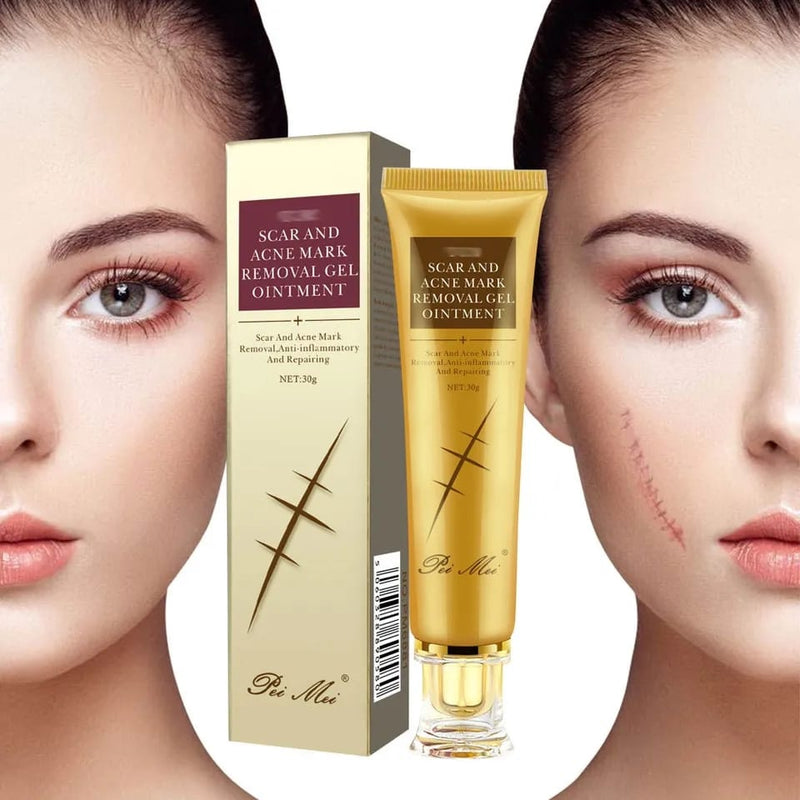 Acne scar remover cream, face cream gel skin care acne treatment cream 30g - Tuzzut.com Qatar Online Shopping