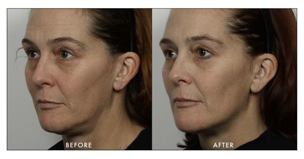 V Shape Facial Toning Device V Shape Facial Toning Device
