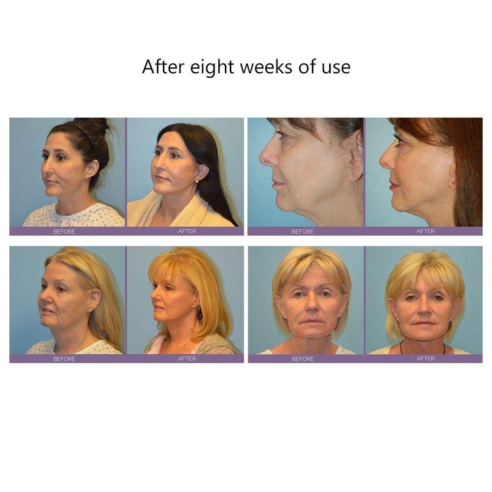 V Shape Facial Toning Device V Shape Facial Toning Device