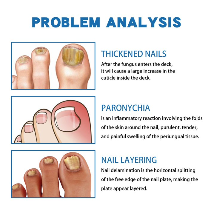 Toe Fungus Hand Foot Removal Gel Nail