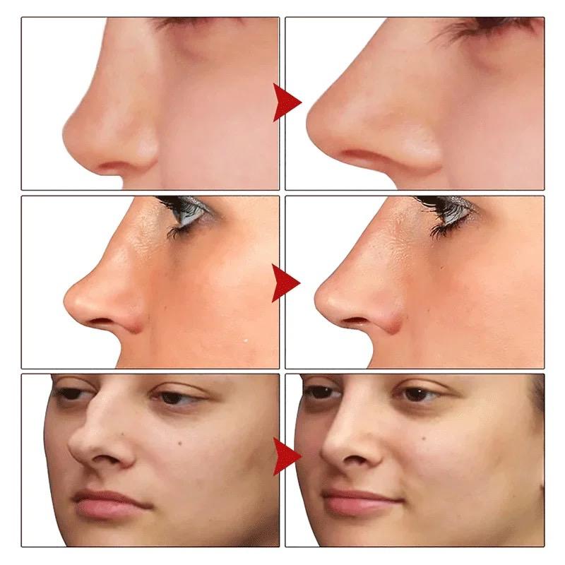 Nose Essential Oil Lift Up Heighten Rhinoplasty Collagen Firming