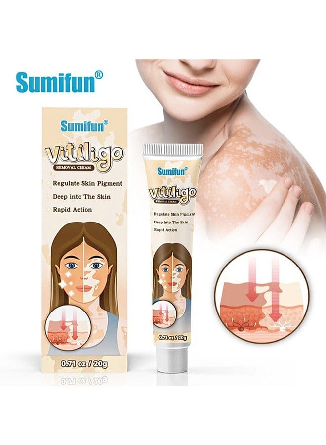 Vitiligo Removal Cream, Skin Vitiligo Treatment, Vitiligo Care Cream Reduces White Spots and Improves Skin Pigmentation (20g) B-389470 Vitiligo Removal Cream, Skin Vitiligo Treatment, Vitiligo Care Cream Reduces White Spots and Improves Skin Pigmentation (20g) B-389470