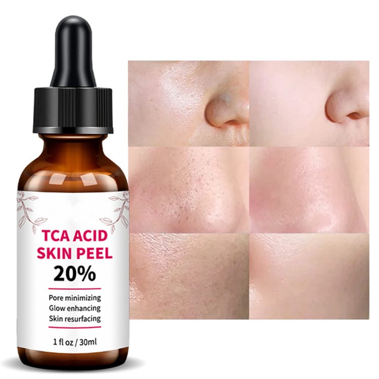 TCA Acid Skin Peel 20% Pore Minimizing Glow Enhancing Skin Resurfacing Serum