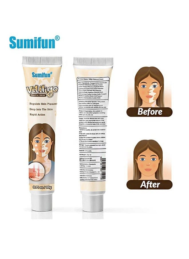 Vitiligo Removal Cream, Skin Vitiligo Treatment, Vitiligo Care Cream Reduces White Spots and Improves Skin Pigmentation (20g) B-389470 Vitiligo Removal Cream, Skin Vitiligo Treatment, Vitiligo Care Cream Reduces White Spots and Improves Skin Pigmentation (20g) B-389470