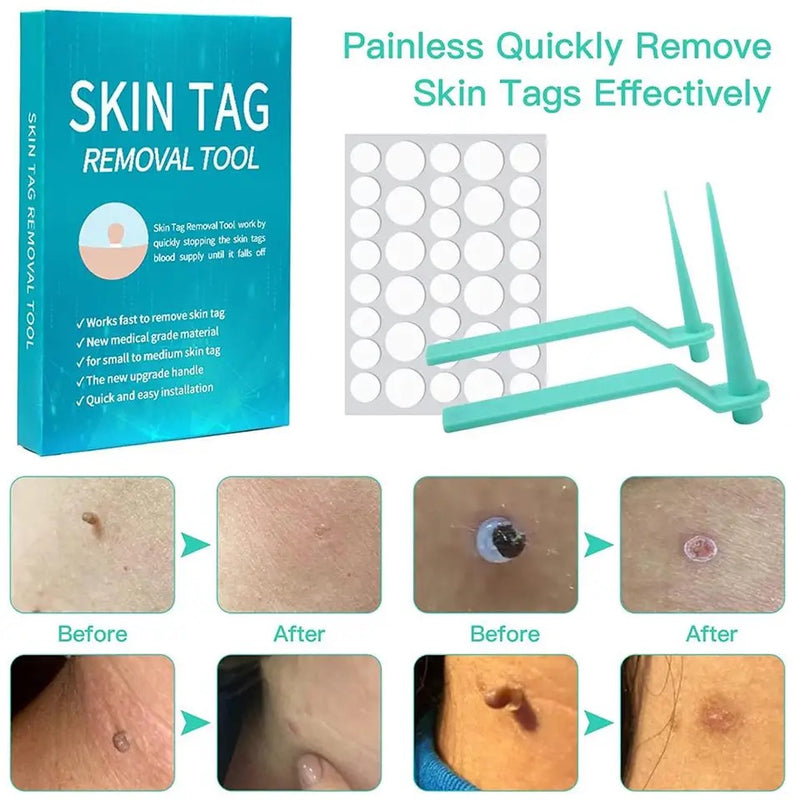 Skin Tag Removal Tool With Cleansing Swabs Home Use Adult Micro Band Non Toxic Face Care Mole Wart Tool - Tuzzut.com Qatar Online Shopping