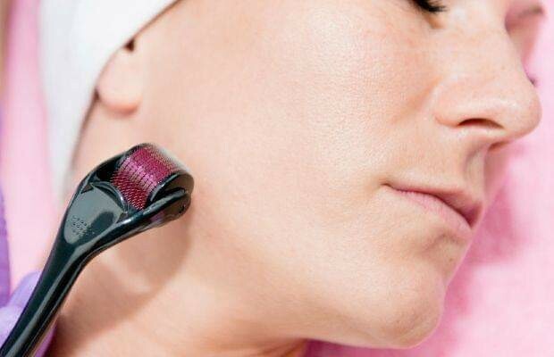 Derma Roller with 540 Stainless Alloy Needles Derma Roller with 540 Stainless Alloy Needles