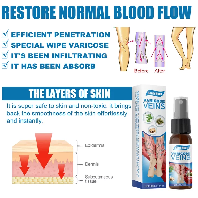 Varicose Veins Spray varicose veins treatment 11/5000 Smoothing Blood Vessel Bulge Smoothing Earthworm Leg 30ml - Tuzzut.com Qatar Online Shopping