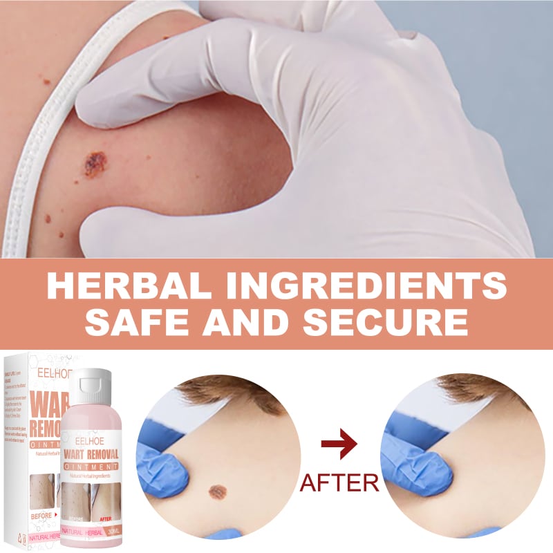 Herbal Wart Skin Removal Ointment - Tuzzut.com Qatar Online Shopping