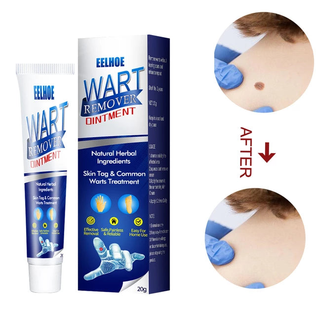 Warts Treatment Cream, Portable Blemish Removal Gel, - Tuzzut.com Qatar Online Shopping