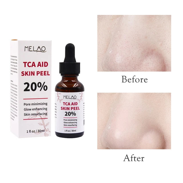 TCA Aid Skin Peel Pores Melao 30ml Trichloroacetic Acid Stock Solution Minimizing Blackheads Solution - Tuzzut.com Qatar Online Shopping