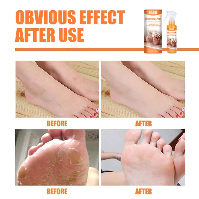 EELHOE Exfoliating Foot Spray For Dead Skin Repair Anti Fungal Calluses Heel Itchy - TUZZUT Qatar Online Store
