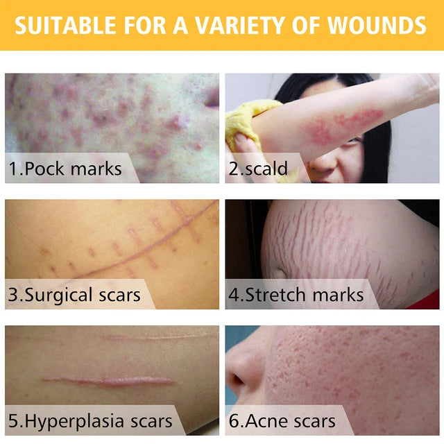 PEI MEI TCM Scar Removal Cream Acne Treatment Acne Control Acne Scar Removal PEI MEI TCM Scar Removal Cream Acne Treatment Acne Control Acne Scar Removal