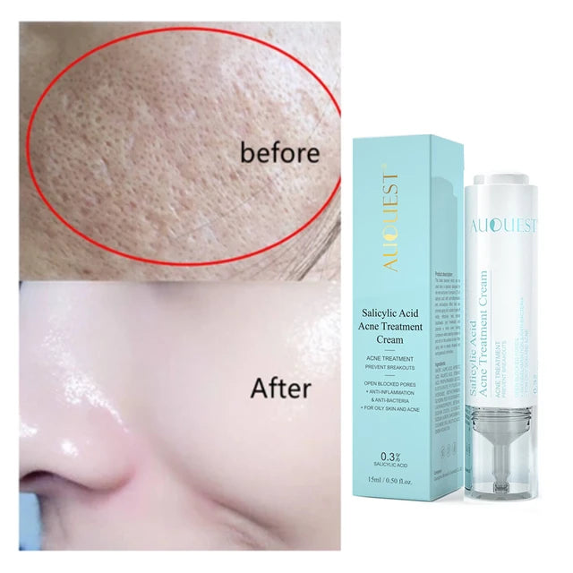 Acne Removal Serum Salicylic Acid Acne Treatment Face Cream - Tuzzut.com Qatar Online Shopping